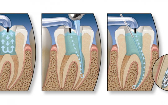 Root Canal Treatments